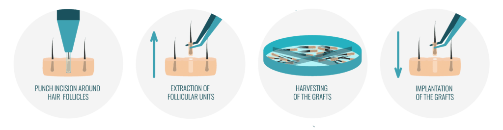 trapianto di capelli tecnica fue amantide