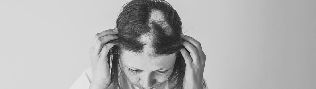 Alopecia Femminile Androgenetica / Aerata / da Stress