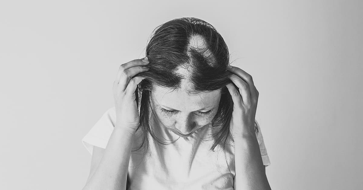 Amantide | Alopecia