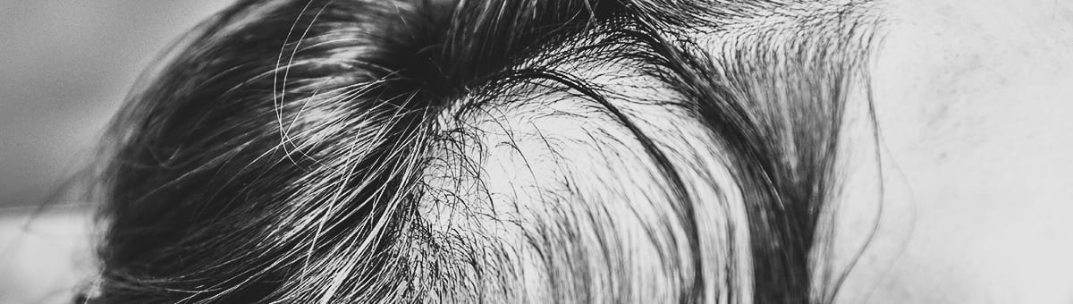 Amantide | Alopecia
