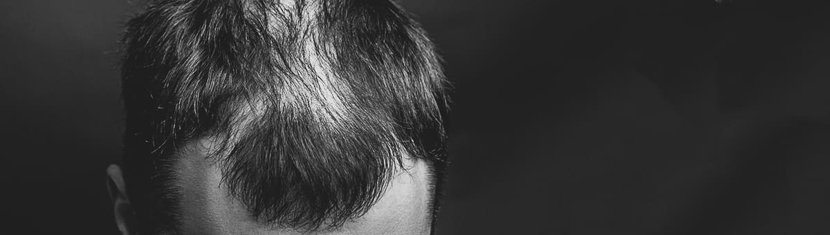 Amantide | Alopecia