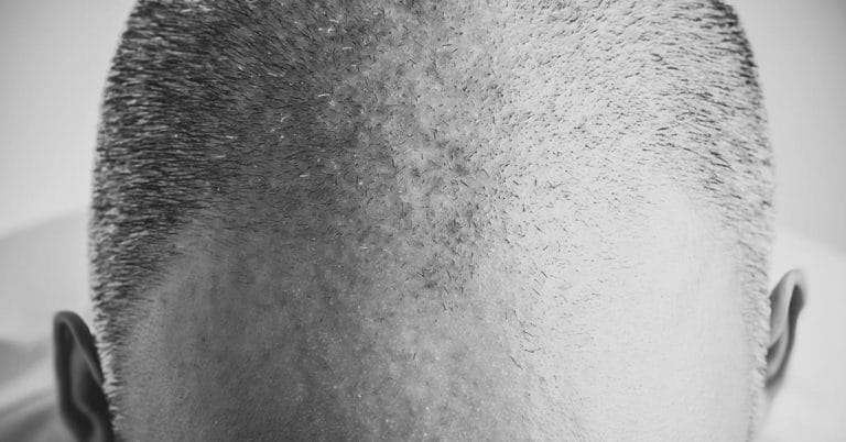 Calvizie: cure definitive per la caduta dei capelli
