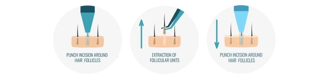 Trapianto Capelli Turchia Tecnica DHI