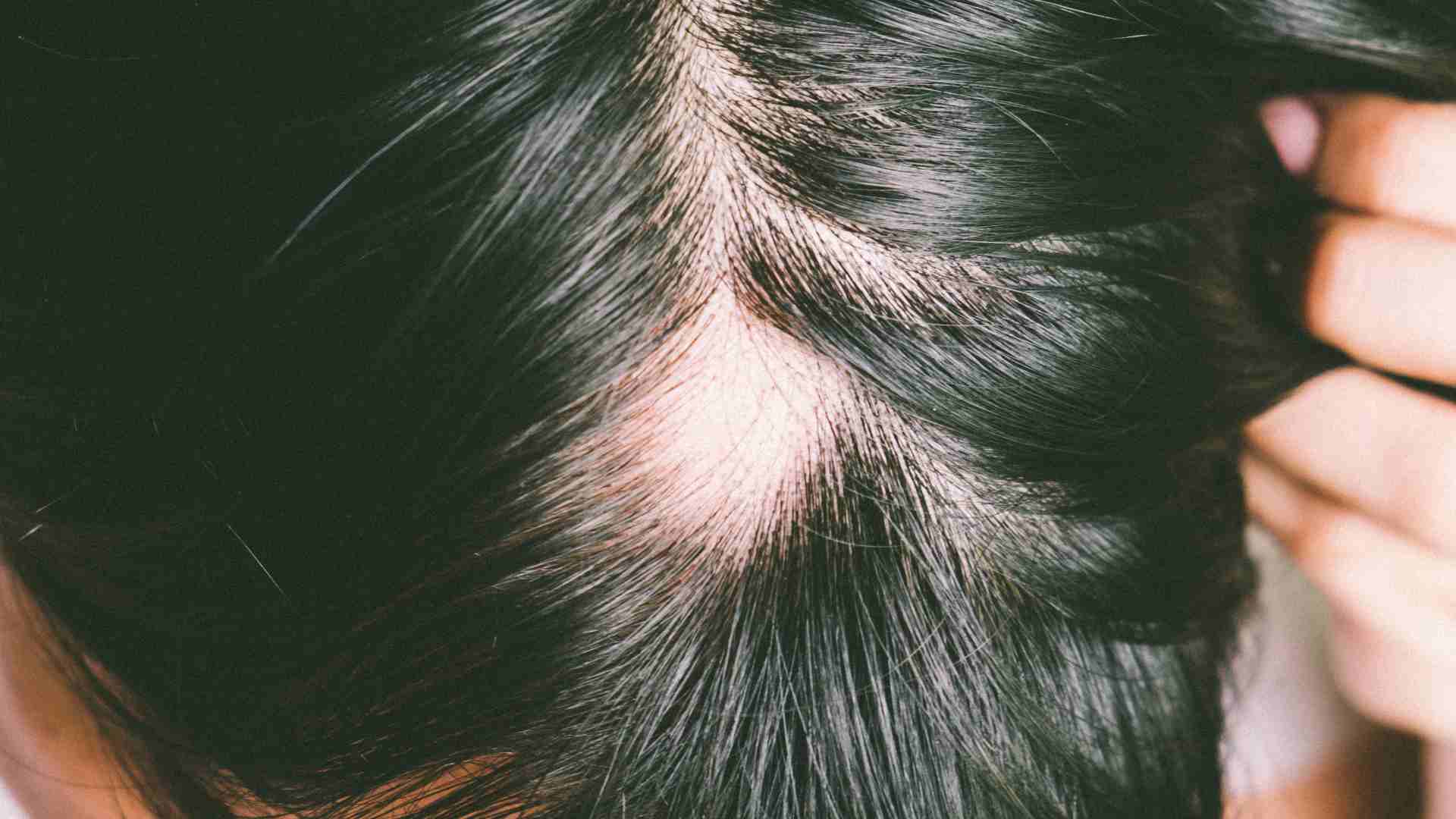 Alopecia Aerata / da Stress / Androgenetica