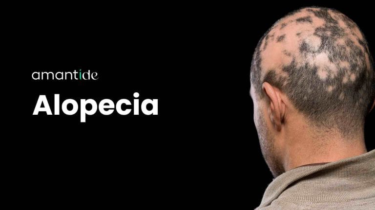 Alopecia