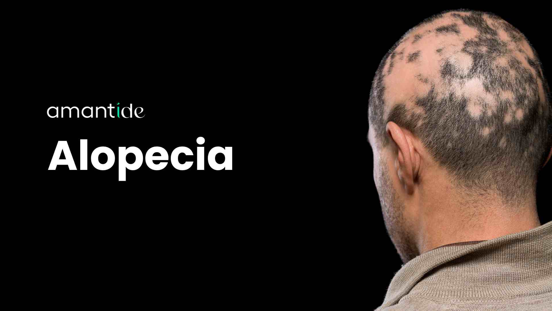Alopecia Androgenetica / Areata / da Stress - Amantide