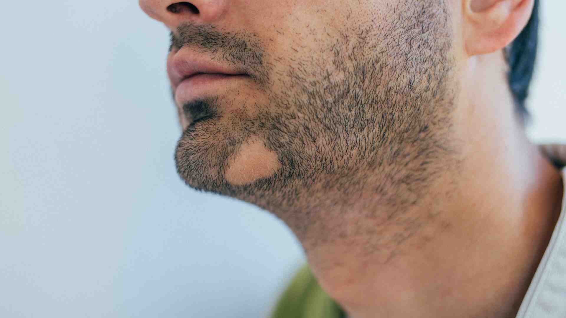 Amantide | Alopecia Barba