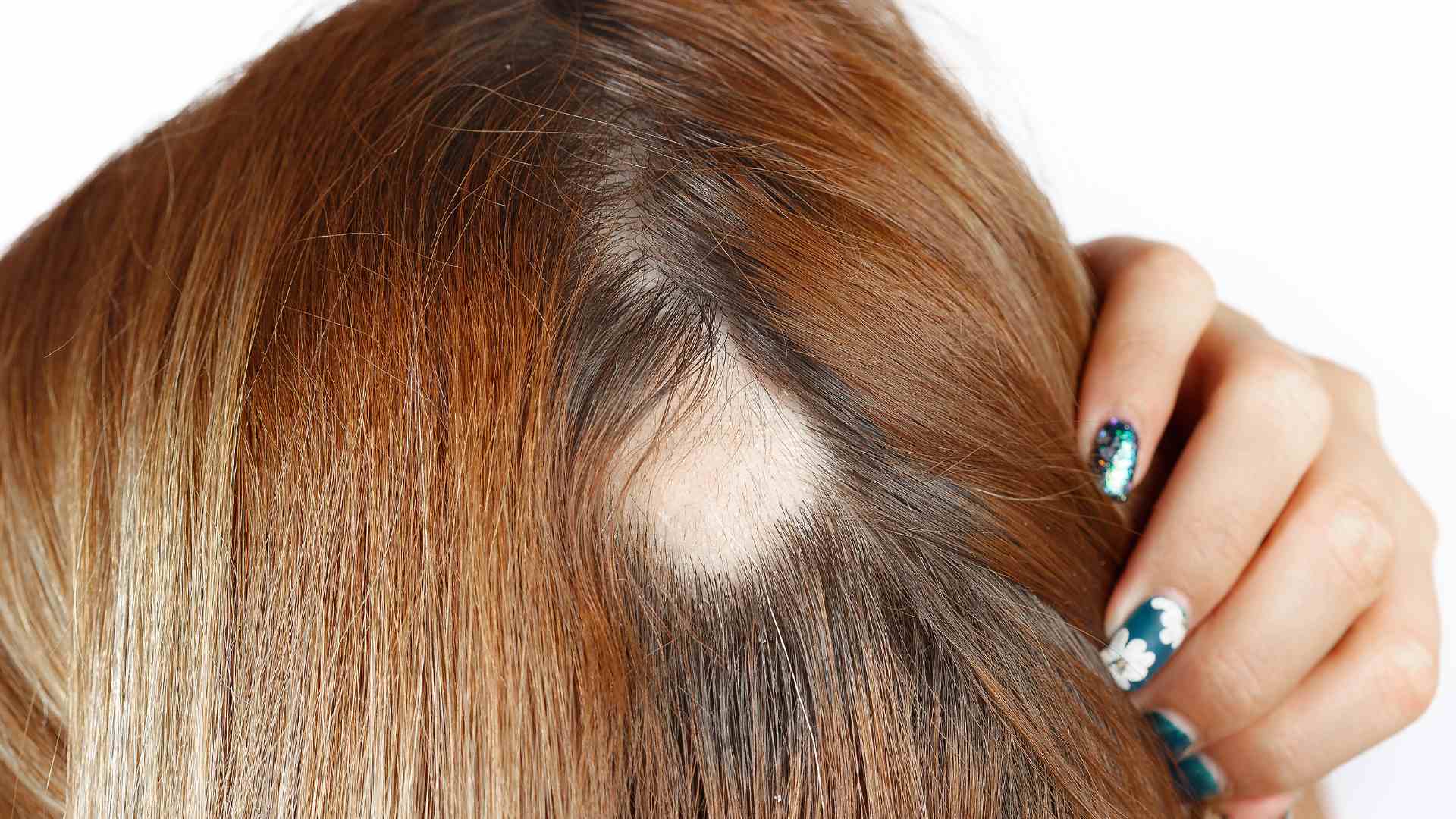 Alopecia Femminile Androgenetica / Aerata / da Stress