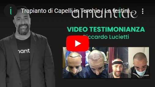 Trapianto Capelli Turchia - Testimonianza Riccardo Lucietti