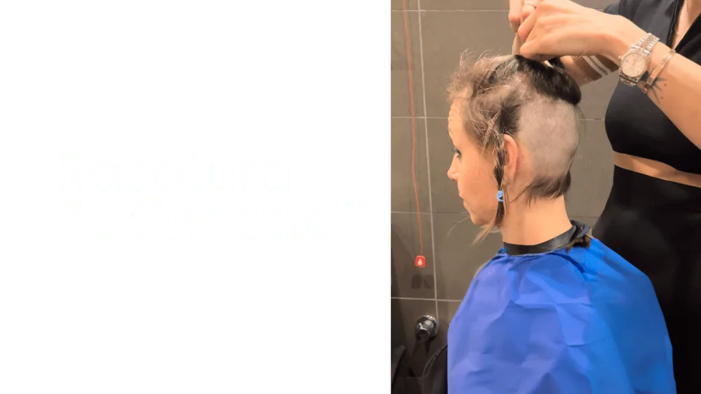 trapianto di capelli donna senza rasatura