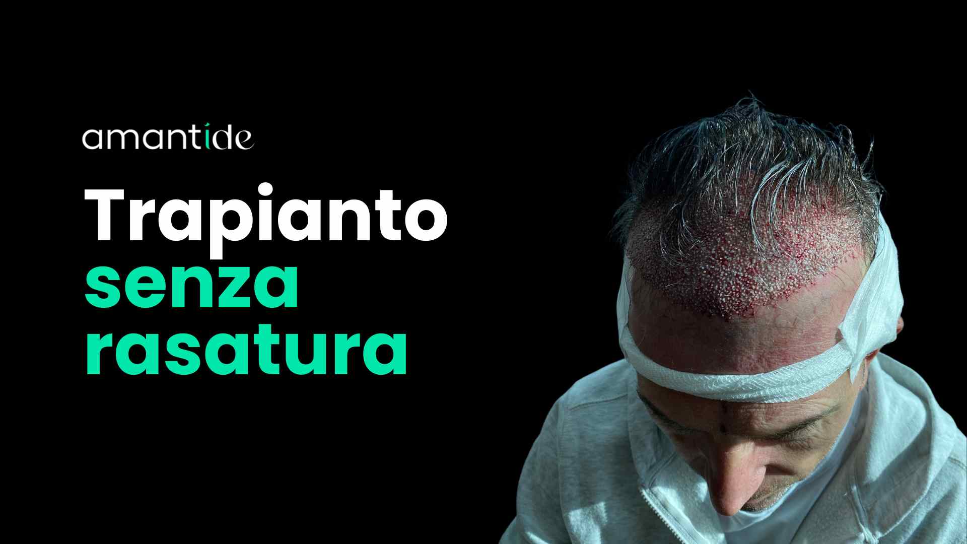 trapianto capelli senza rasatura