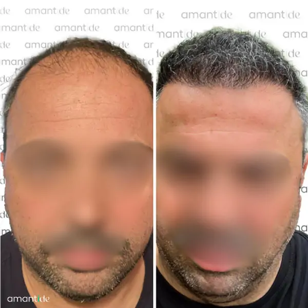 trapianto di capelli in turchia