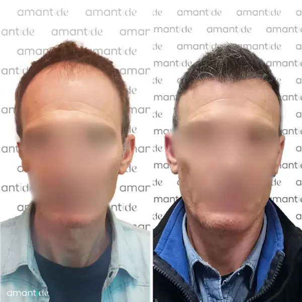 trapianto capelli turchia prima e dopo amantide