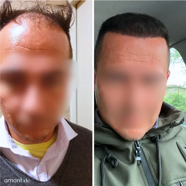 trapianto capelli in turchia