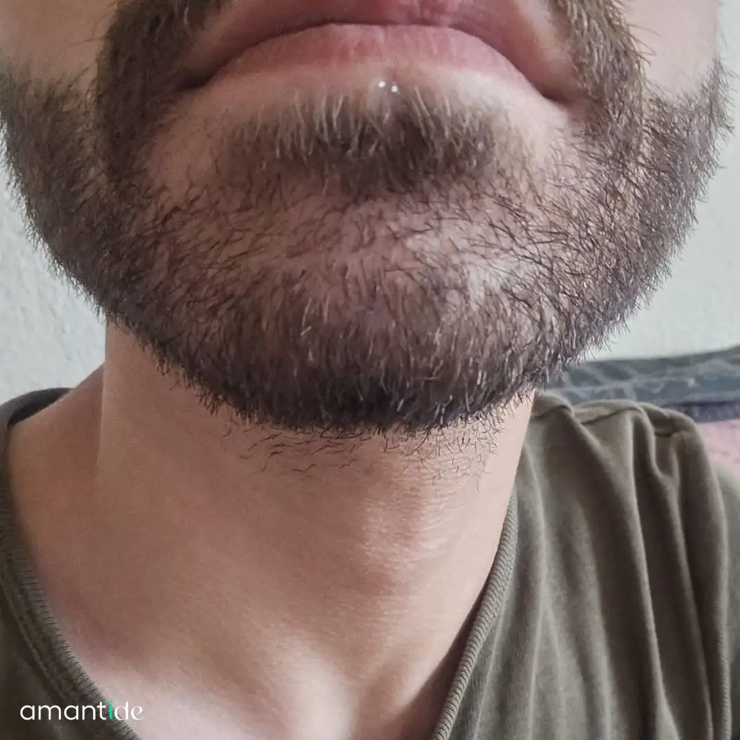 Trapianto barba procedura 5