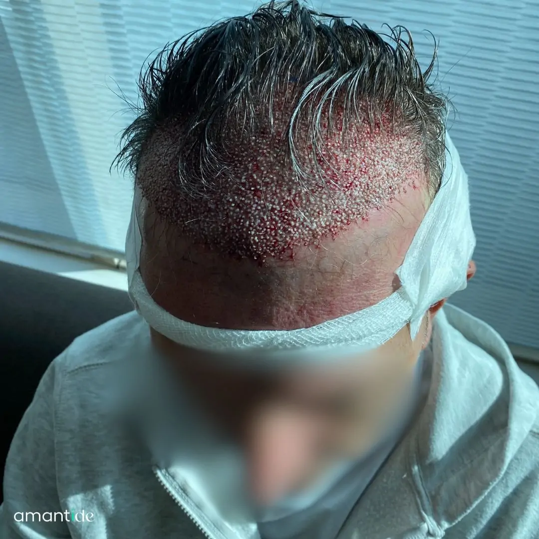 Trapianto capelli Turchia Amantide
