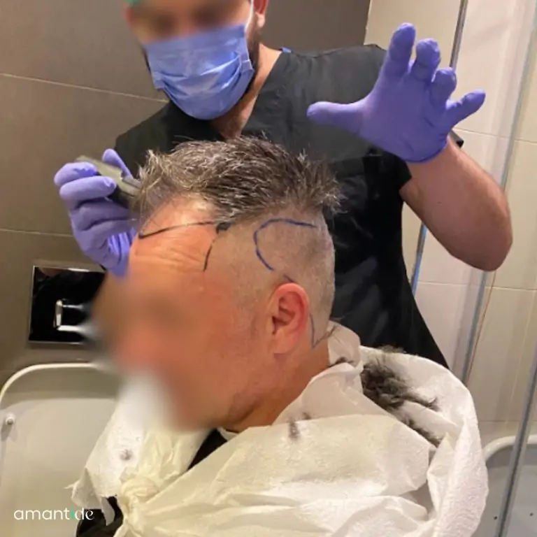 Trapianto senza rasatura