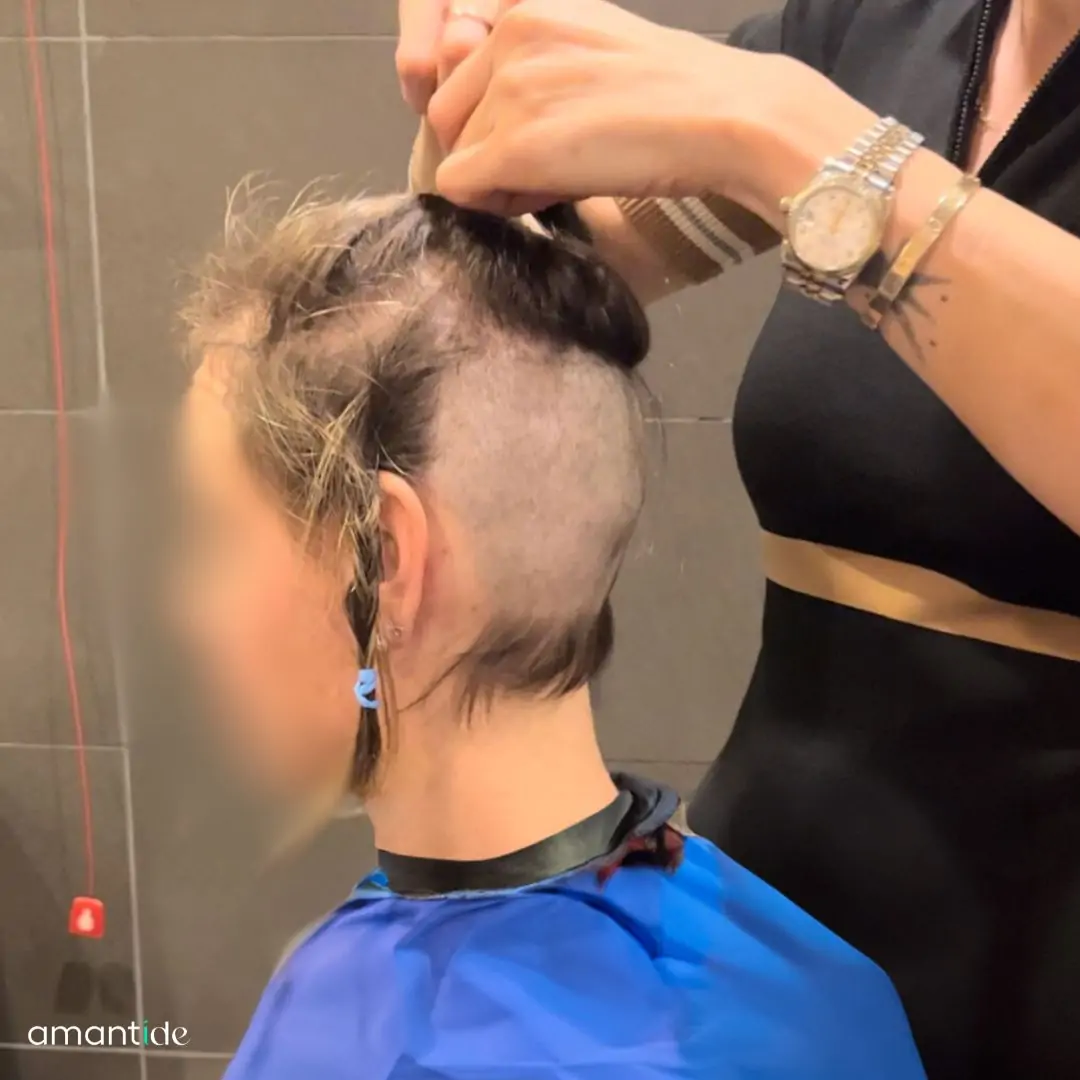Trapianto capelli donna senza rasatura