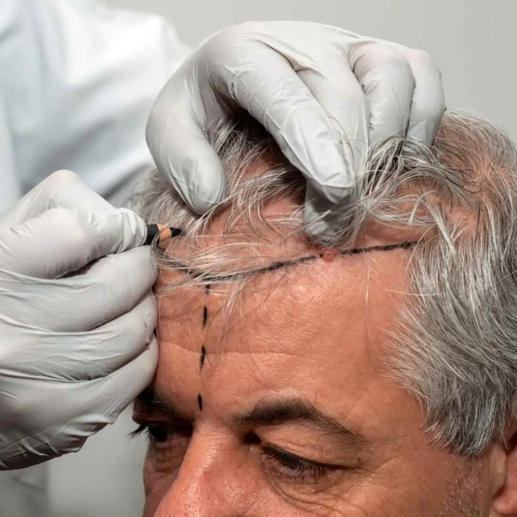 trapianto capelli turchia costi_01