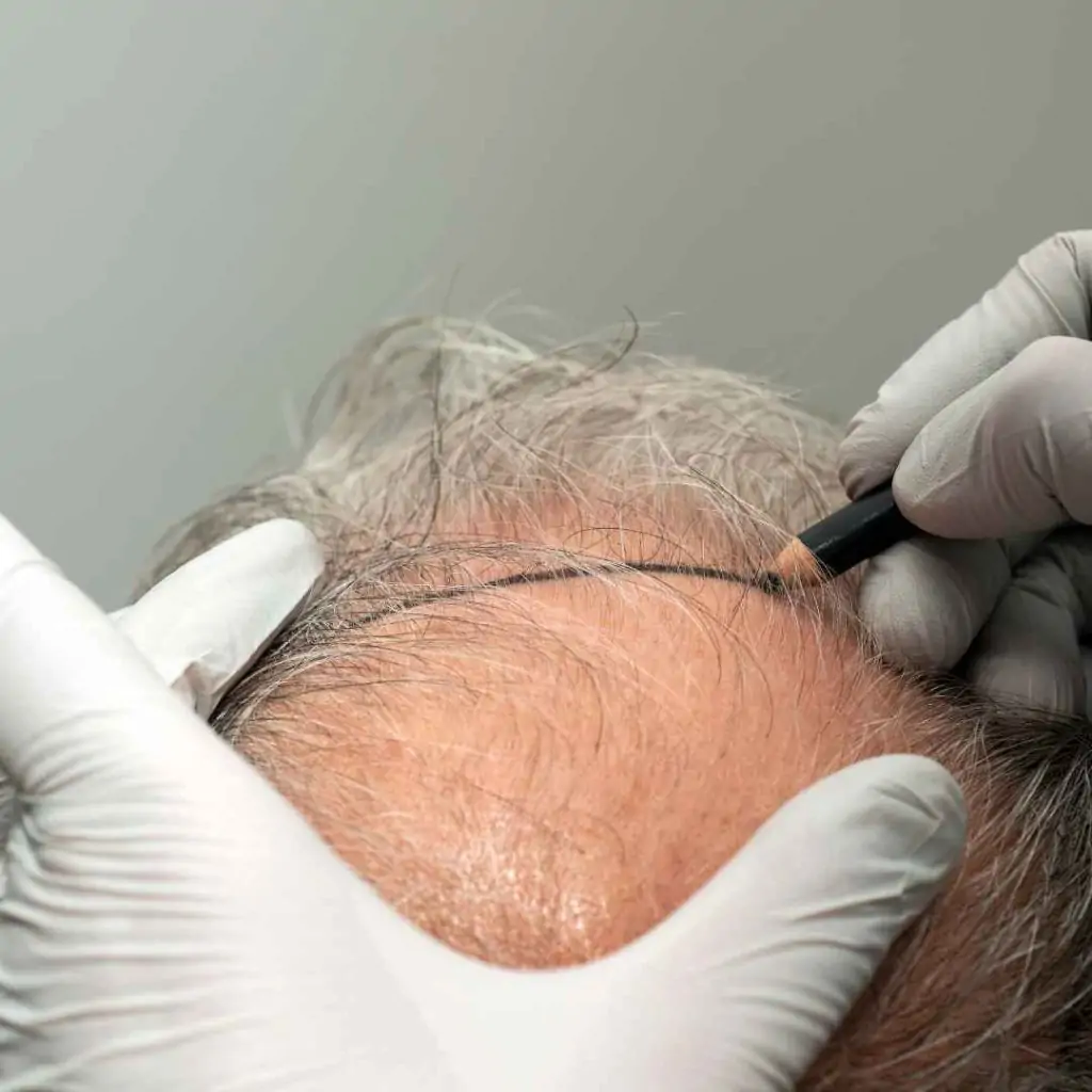 trapianto capelli turchia costi_02