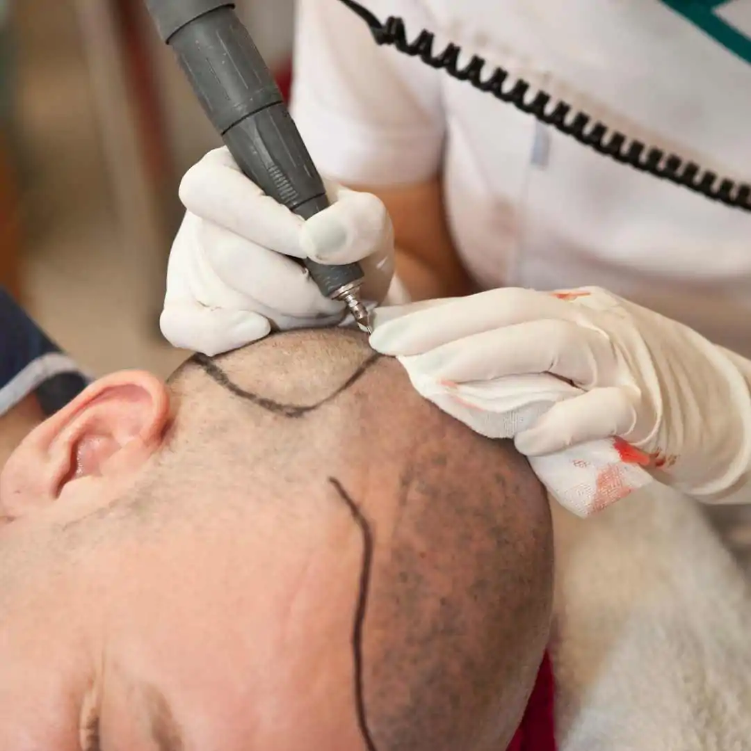 Trapianto capelli costi Amantide