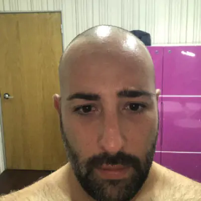Fase 1 trapianto capelli — Pre-operatorio