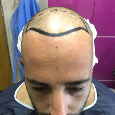 Fase 2 trapianto capelli — Intervento