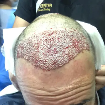 Fase 3 trapianto capelli — Post-operatorio