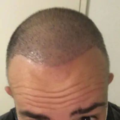 Fase 5 trapianto capelli — Risultato