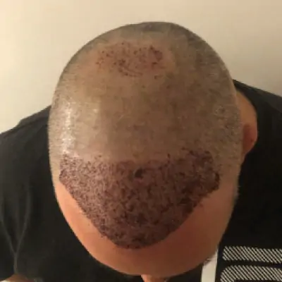 Fase 4 trapianto capelli — Ricrescita