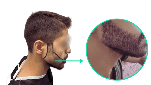 trapianto-capelli-turchia-prima-e-dopo