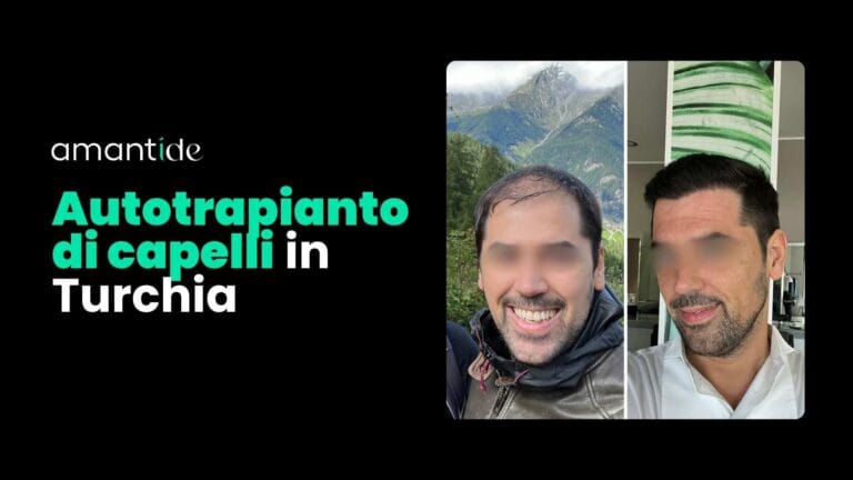 Autotrapianto capelli Turchia