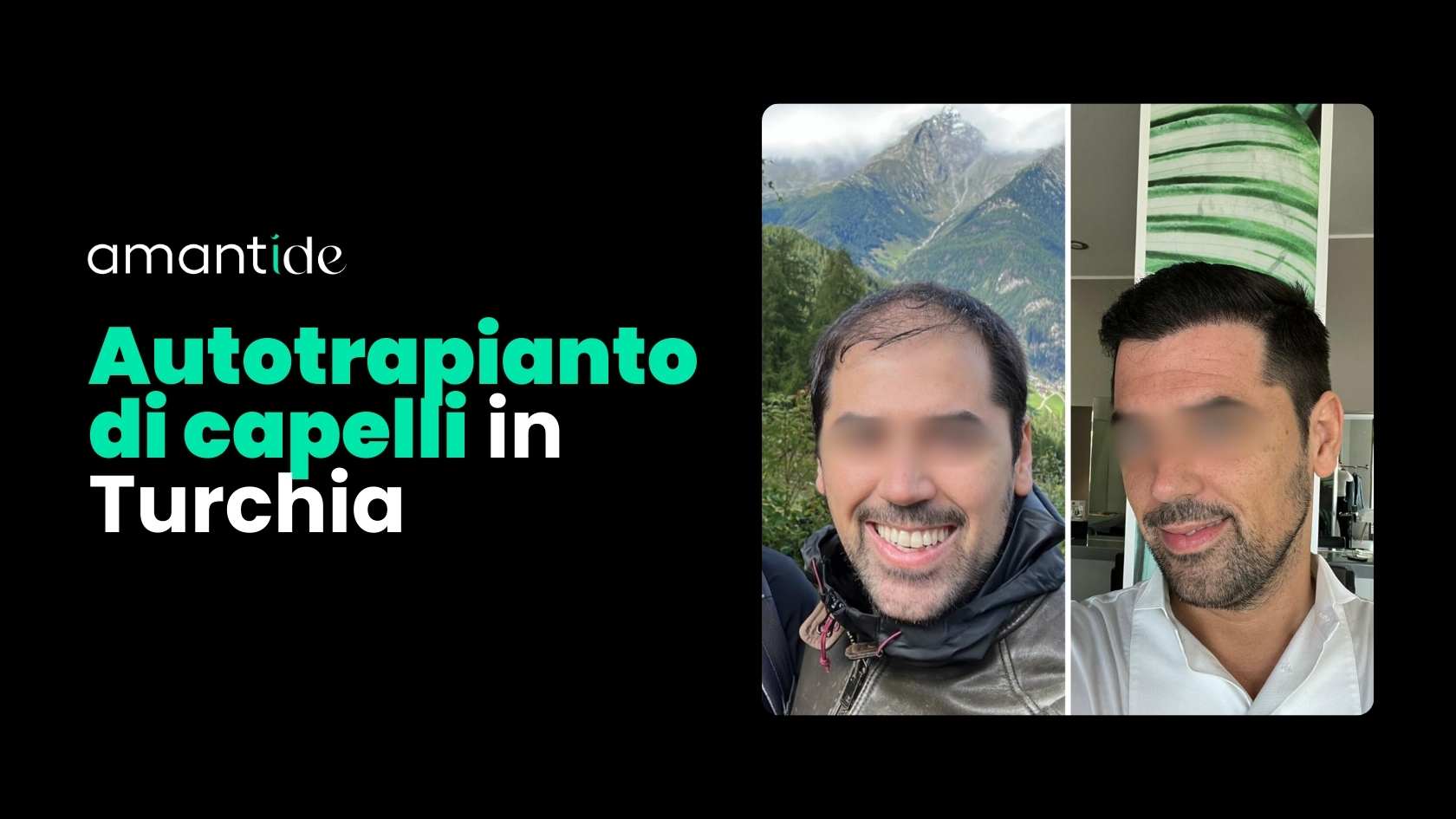 autotrapianto capelli turchia | amantide