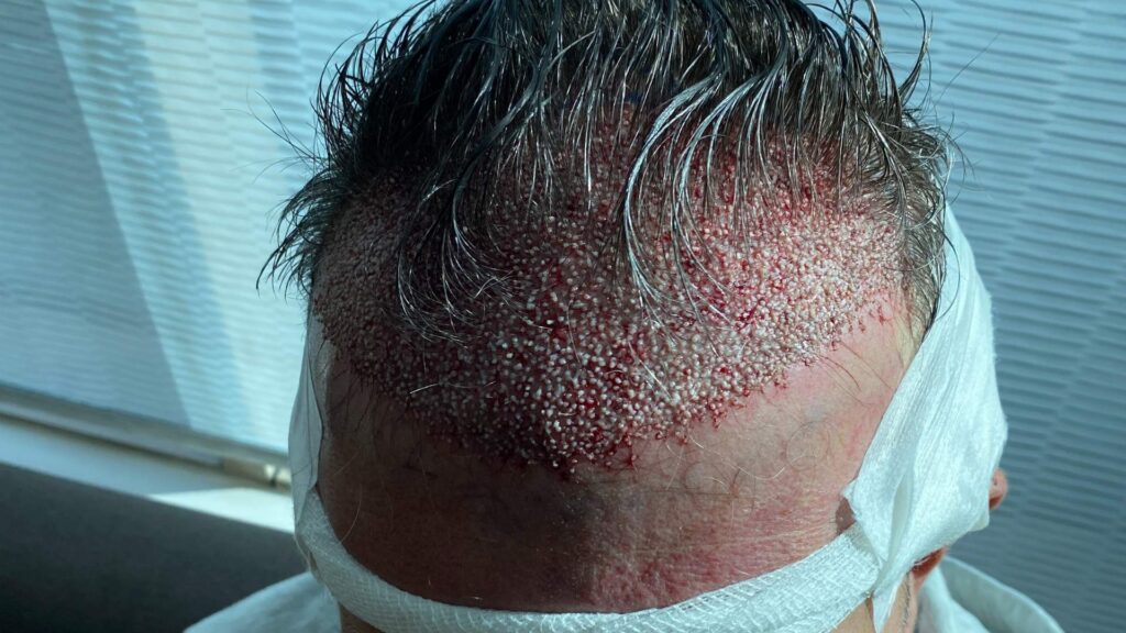 il trapianto di capelli funziona | amantide