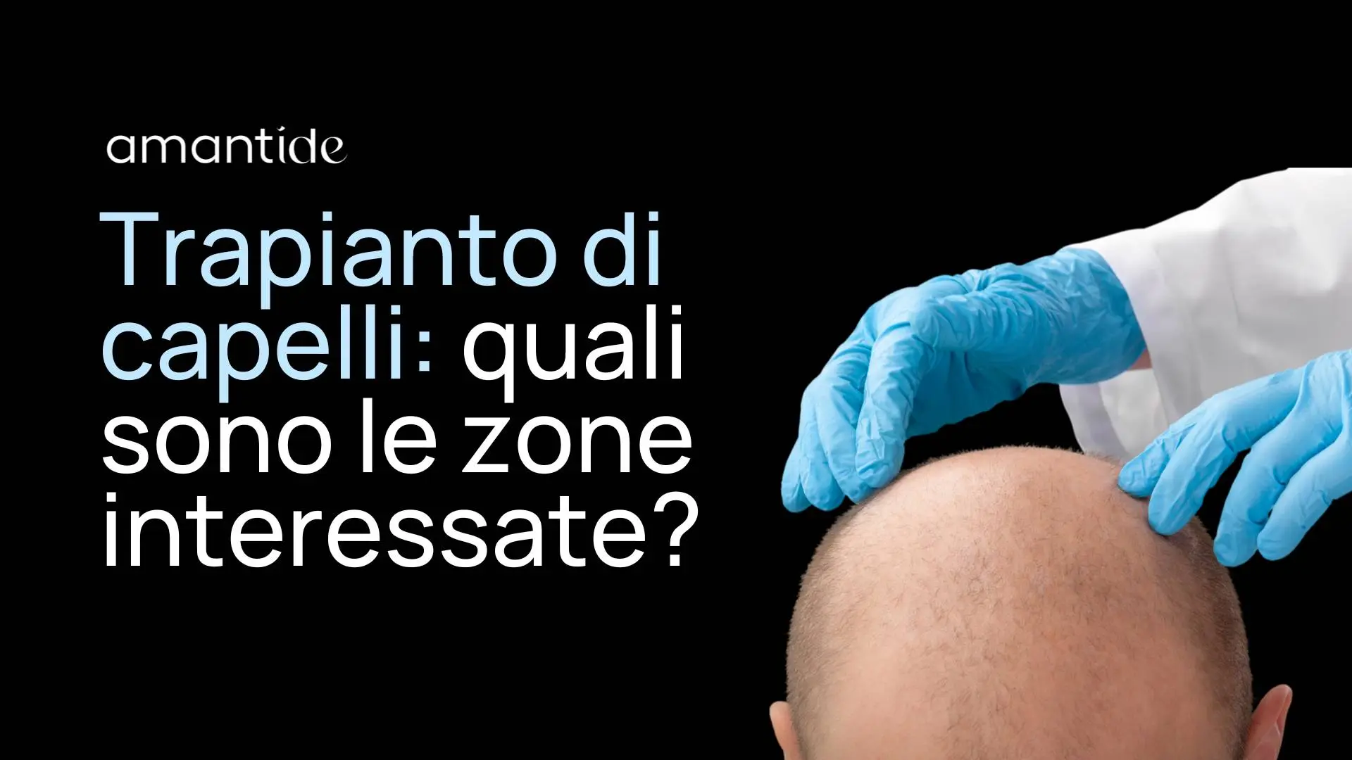 trapianto di capelli quali sono le zone interessate | amantide
