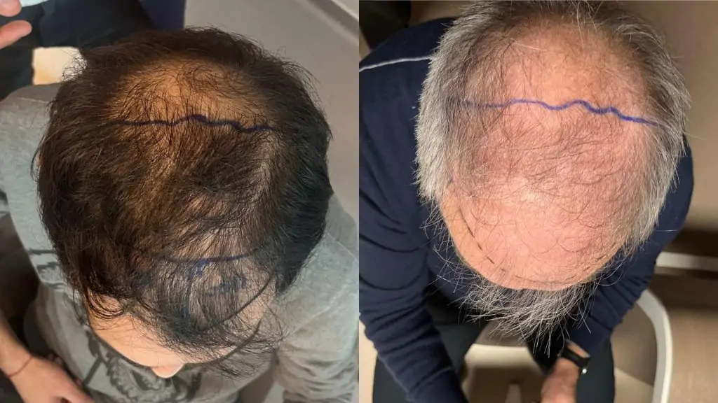 trapianto di capelli quali sono le zone interessate | amantide | trapianto parziale 3