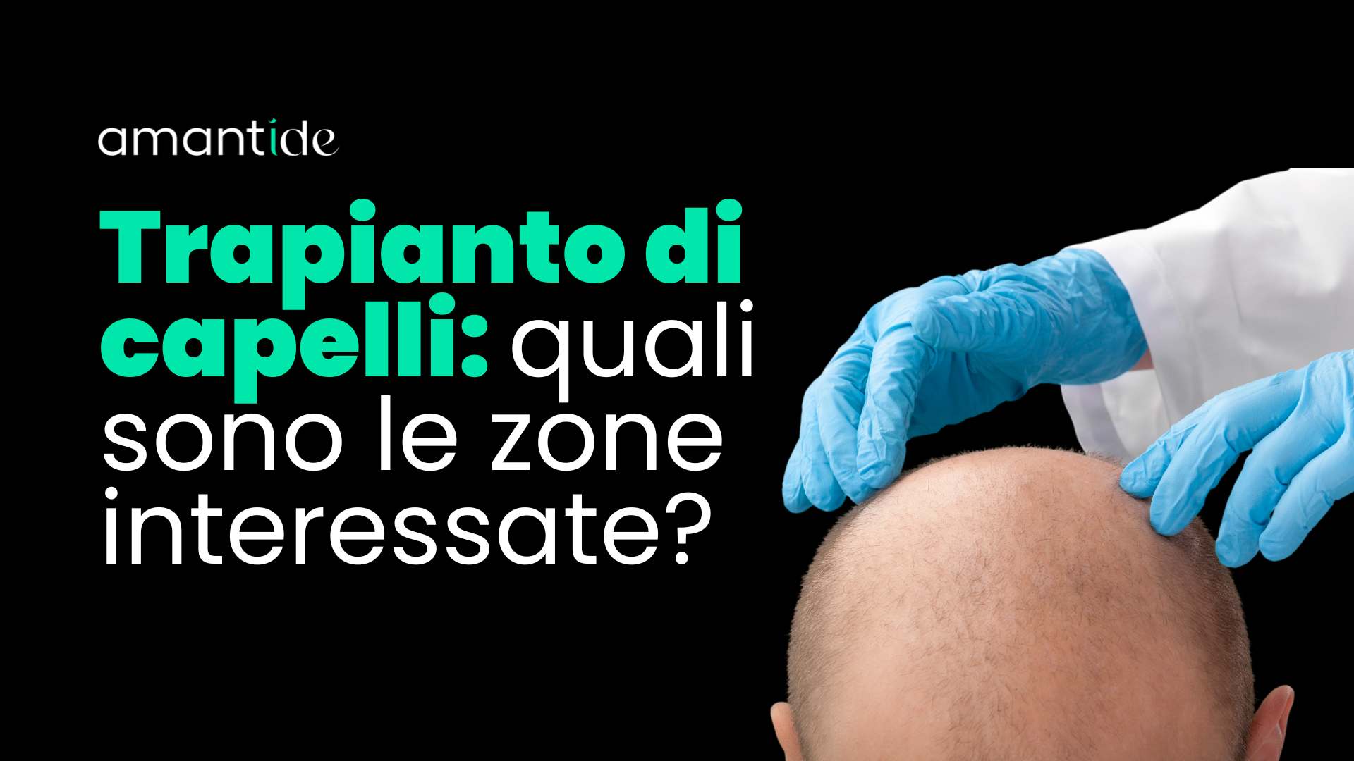 trapianto di capelli quali sono le zone interessate | amantide
