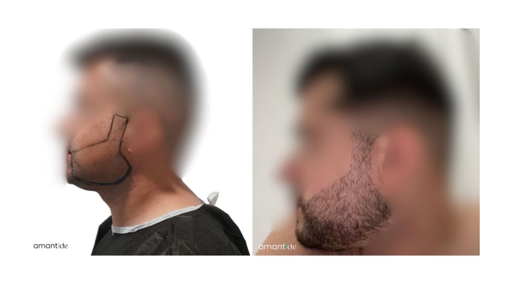 barba poco folta | trapianto di barba | amantide