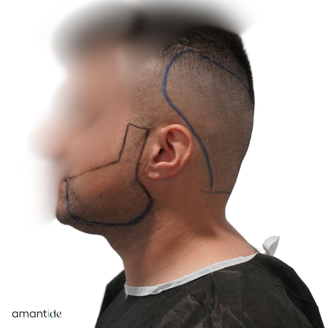 trapianto barba turchia