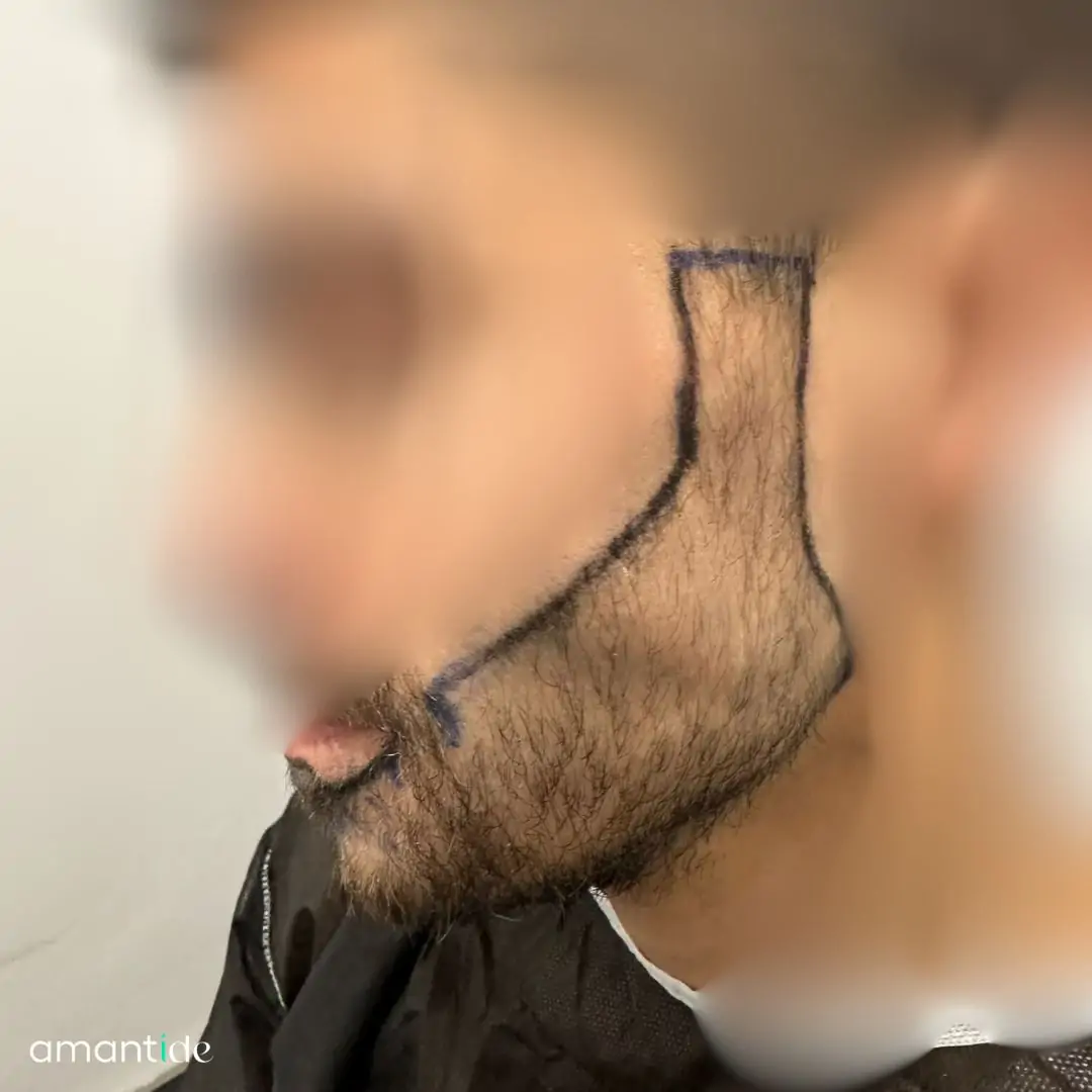 Trapianto barba procedura 1