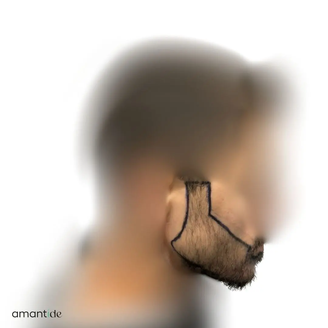 Trapianto barba procedura 2