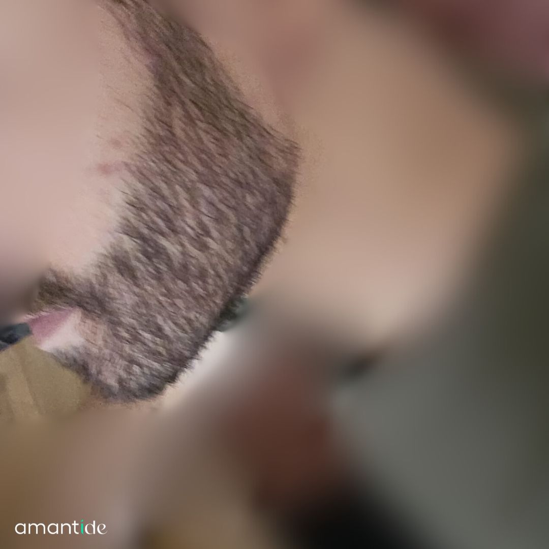 trapianto barba risultati