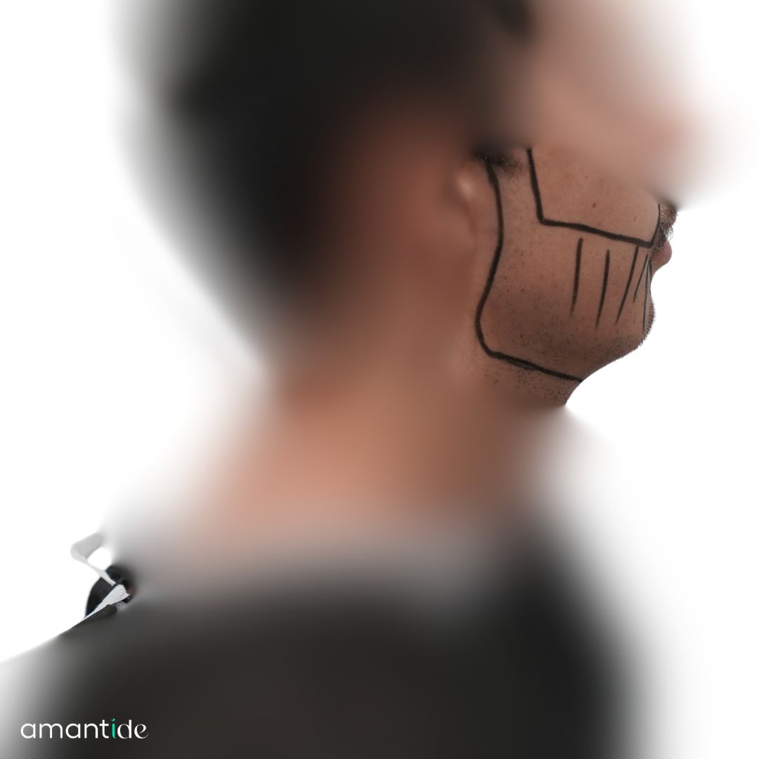 trapianto barba prima e dopo