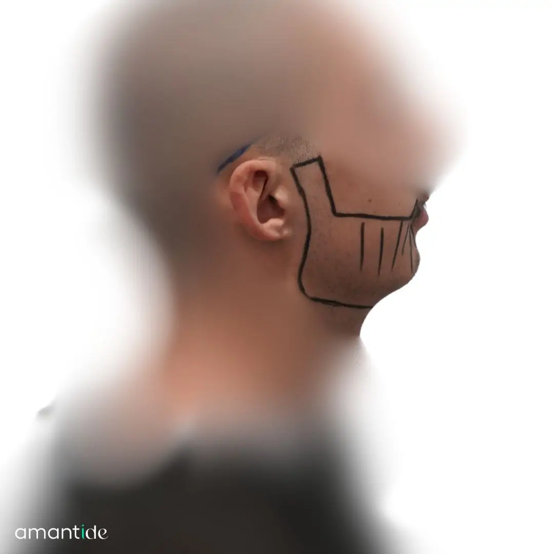 Trapianto barba risultato 1