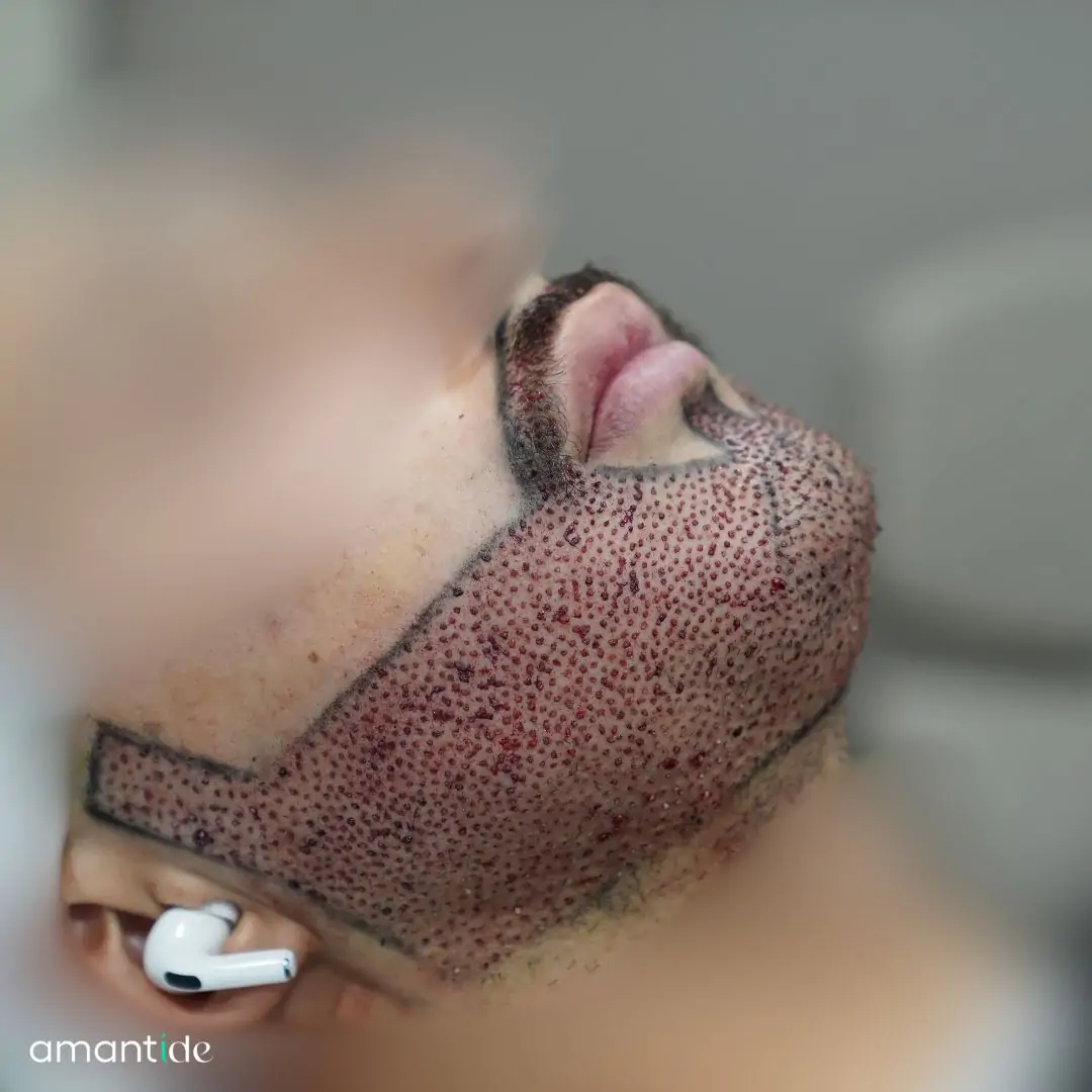 Trapianto barba risultato 2