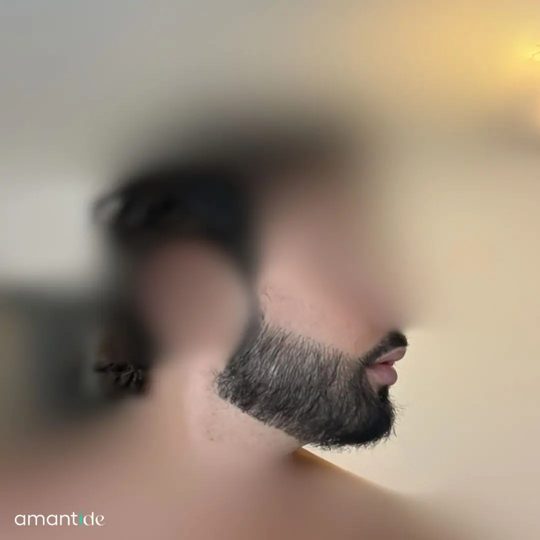 Trapianto barba risultato 3