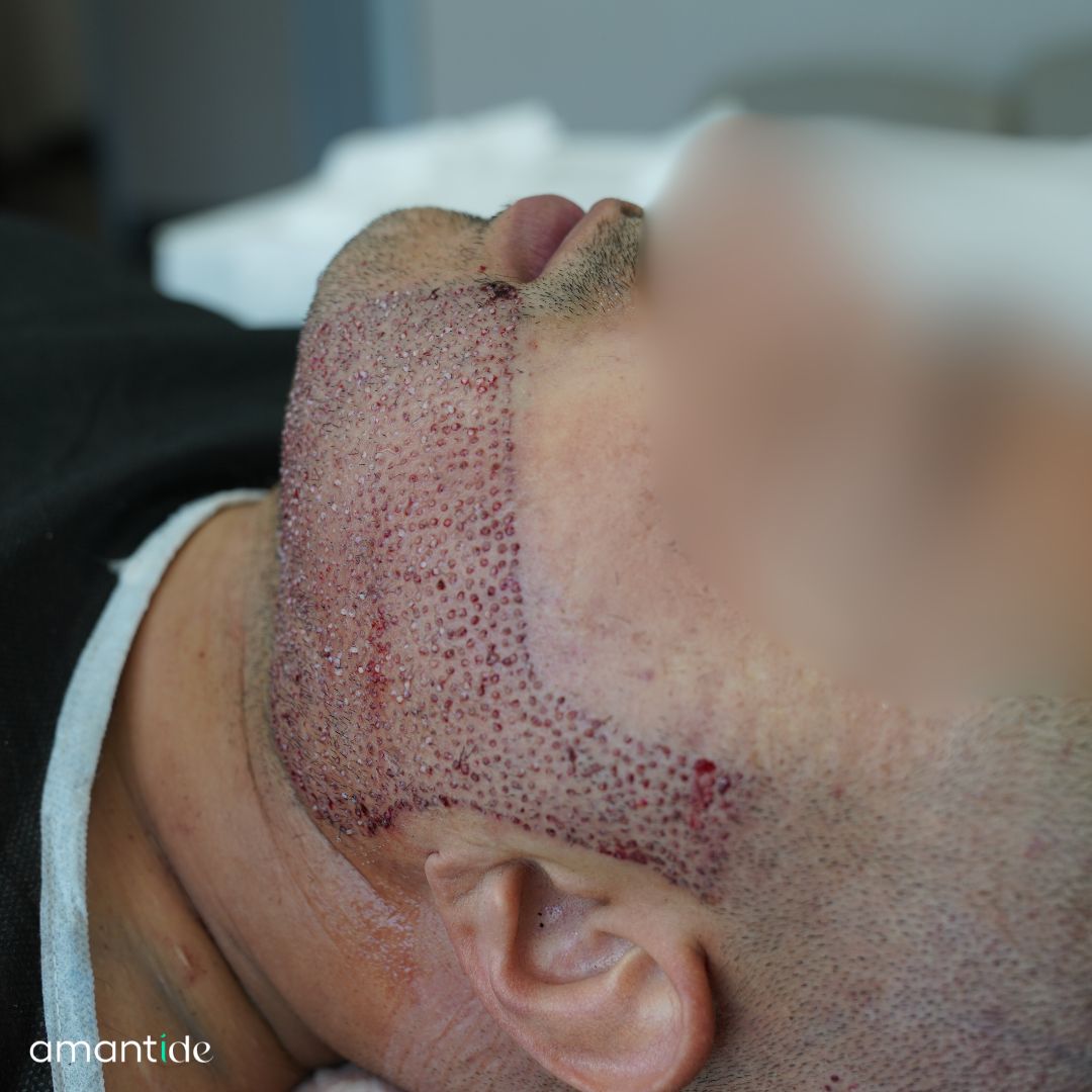 trapianto barba turchia tecnica dhi