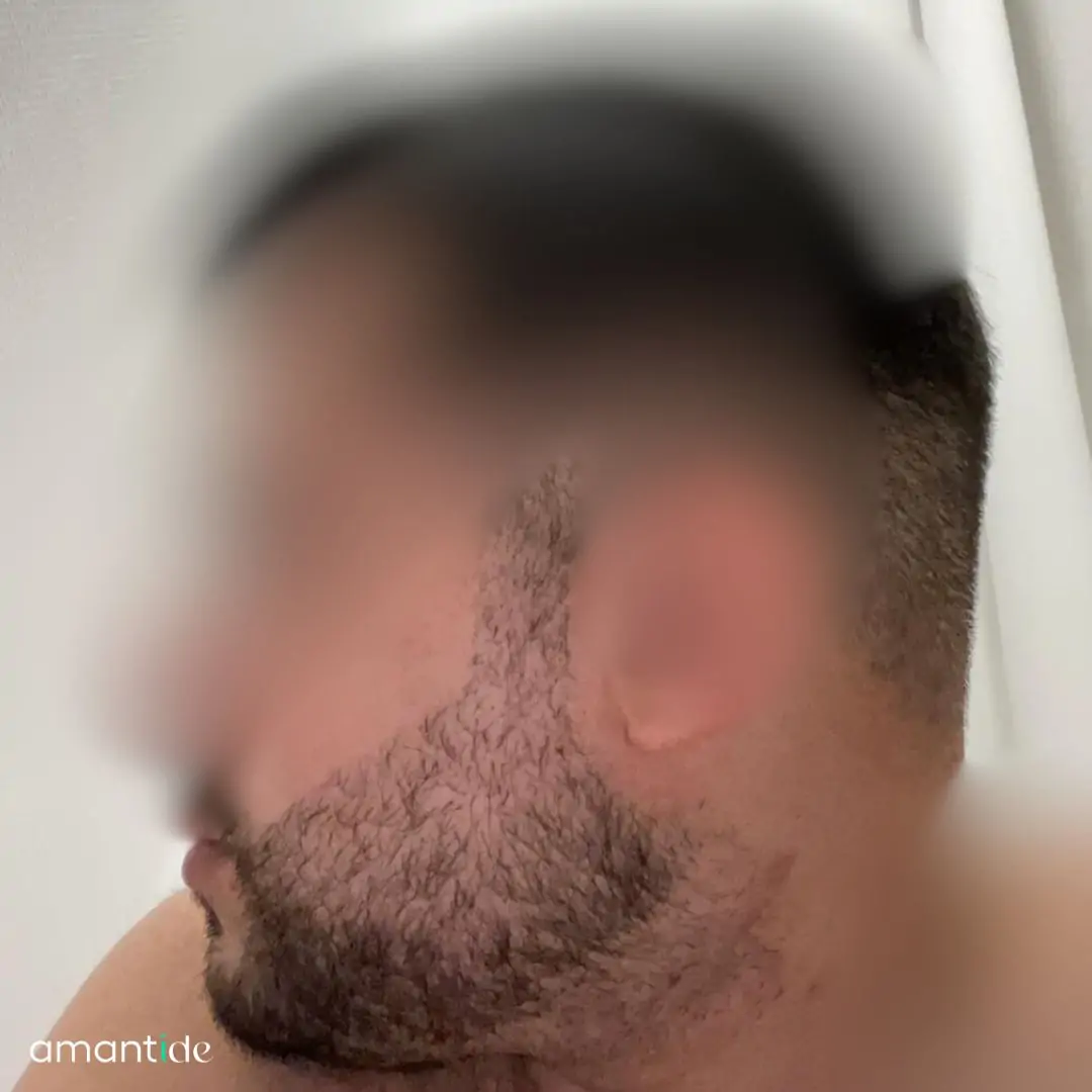 Risultato trapianto barba 2