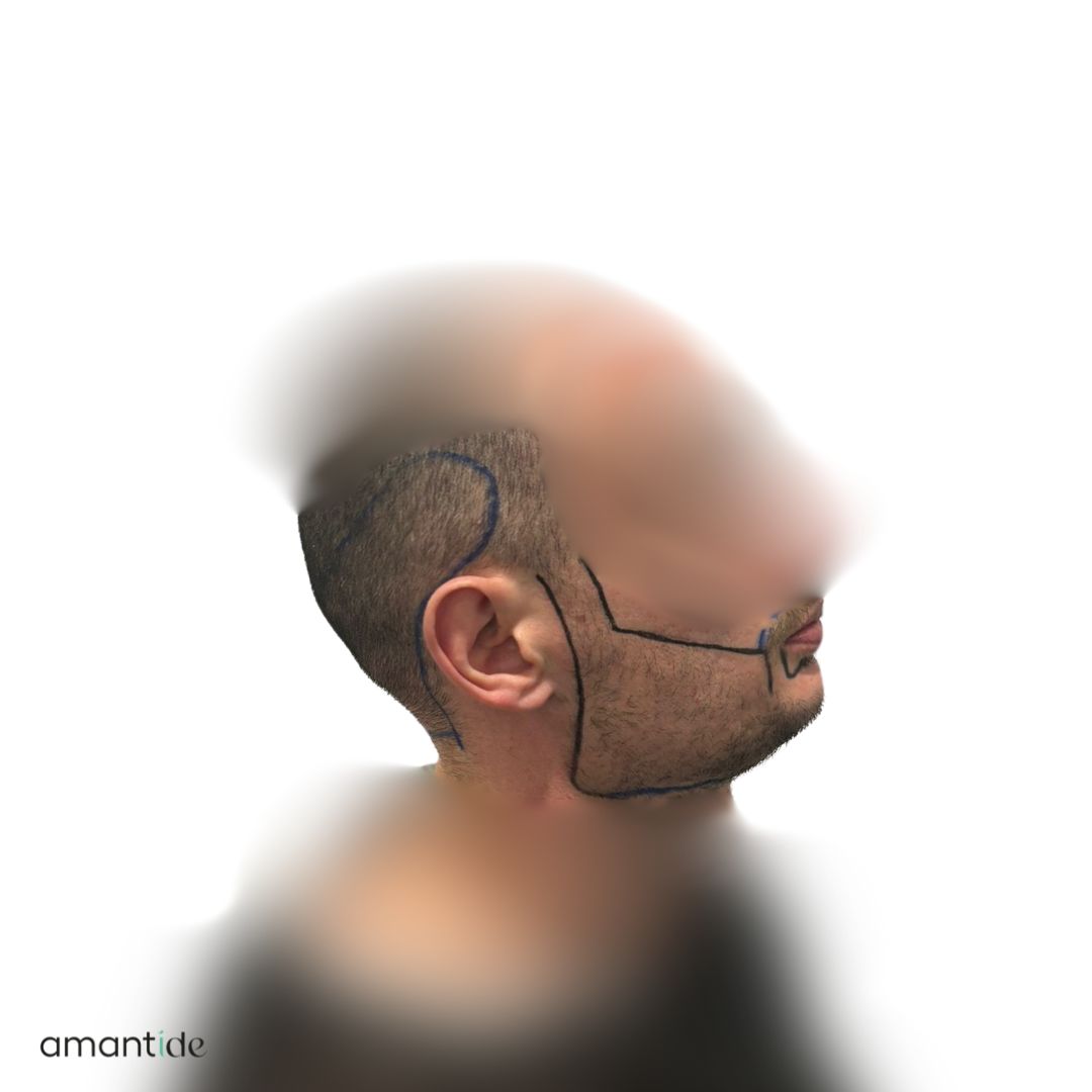 trapianto barba turchia