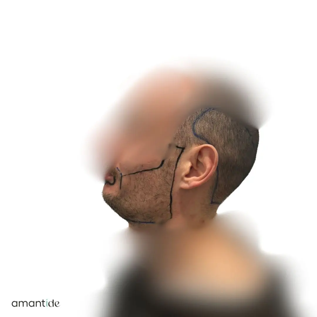 Prima e dopo barba 1